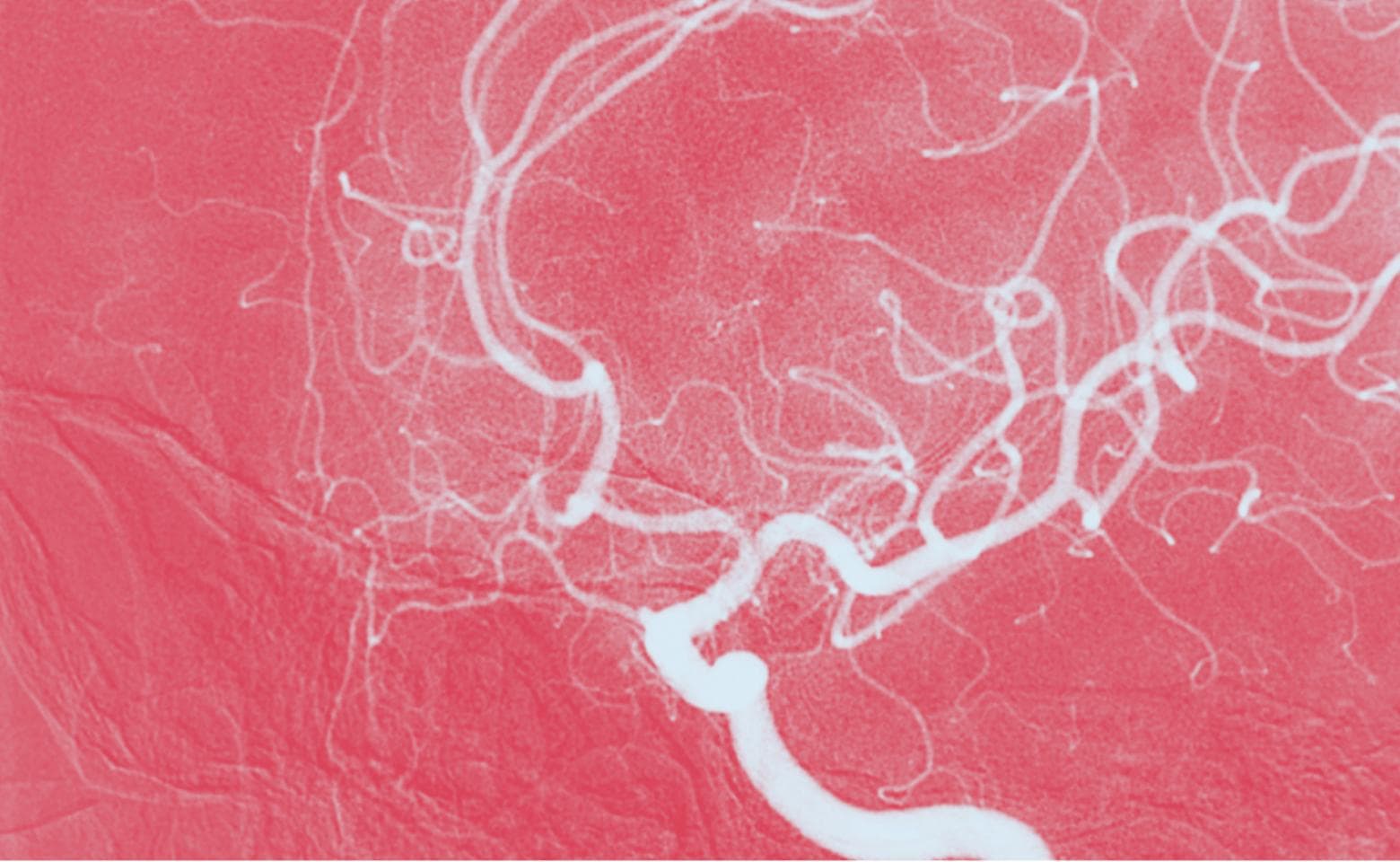 Immagine DSA dell'arteria carotide interna
